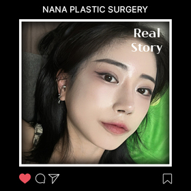 김신영님의 기본코 매부리 긴코 자가늑 재수술 후기