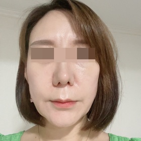혜띠님의 안면거상 후기