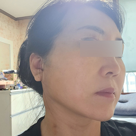 진황님의 안면거상 후기