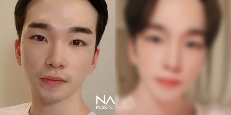 男性整形 术前术后 — 术前术后