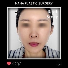 고성아님의 안면거상 후기