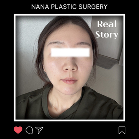 기미근아님의 포니테일리프팅 후기