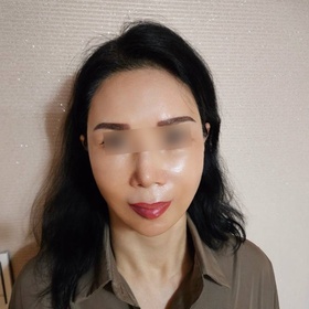 철수와영휘님의 안면거상 후기