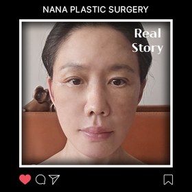 김혜미님의 안면거상 후기