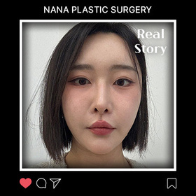 강은유님의 비절개눈매교정, 듀얼트임 후기