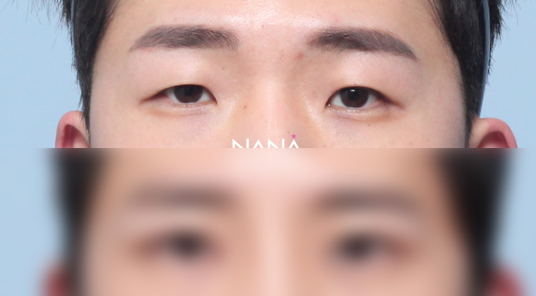 术前术后 术前术后