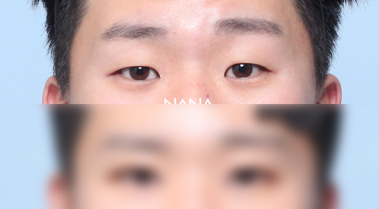 术前术后 术前术后