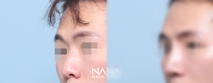 术前术后 术前术后