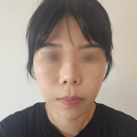 이미경님의 안면거상 후기