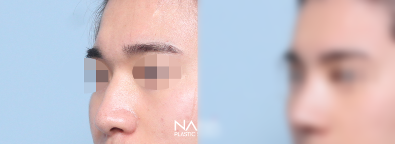 전후사진 전후사진