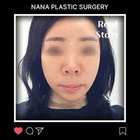 김명희님의 안면거상 후기