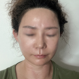 선선한여름밤님의 안면거상 후기