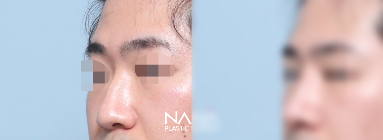 전후사진 전후사진