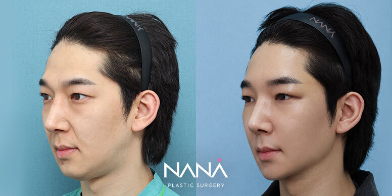 전후사진 전후사진