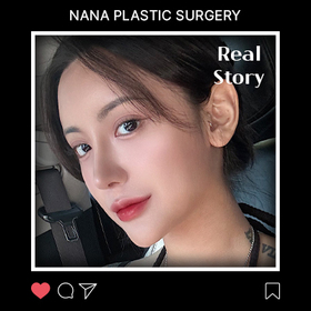 정지윤님의 콧대 코끝 짧은코 기증늑 후기