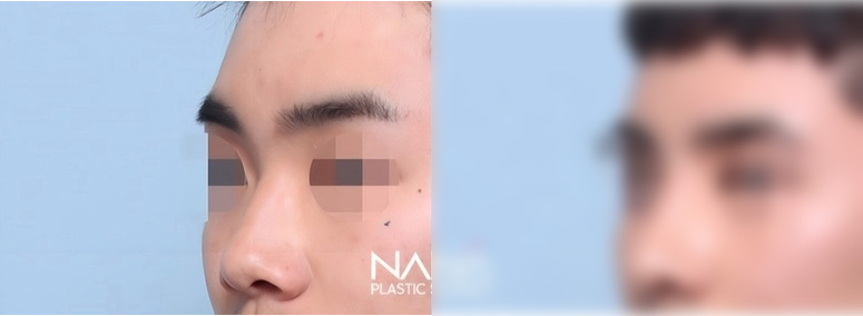 전후사진 전후사진