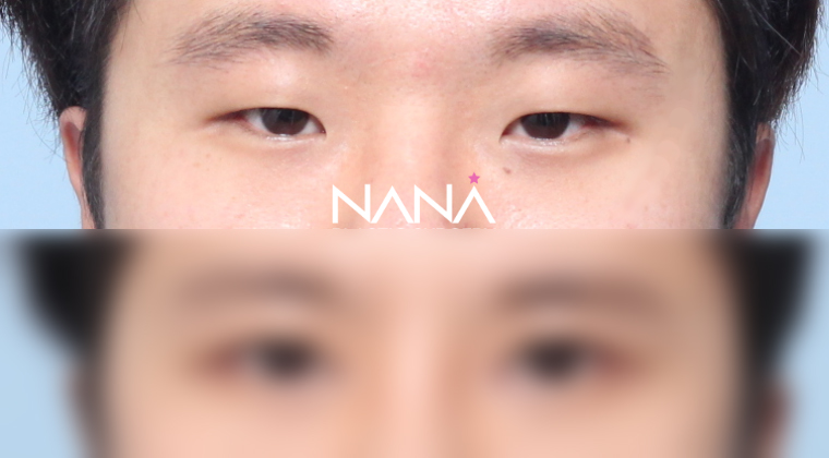 전후사진 전후사진