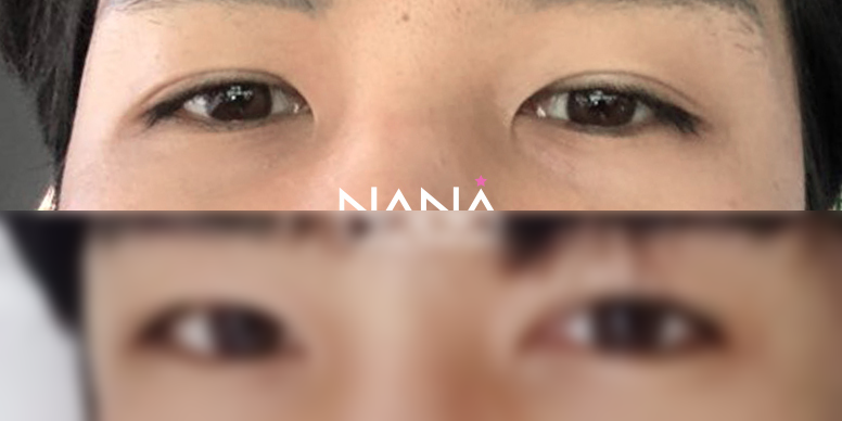 男性整形 术前术后 — 术前术后