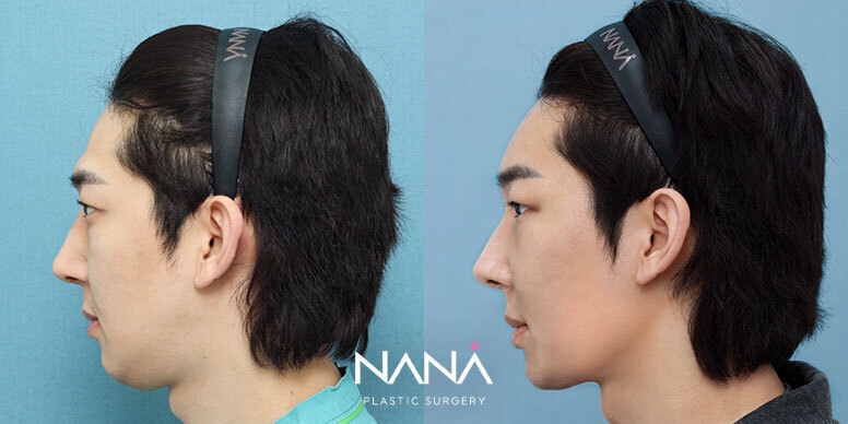 전후사진 전후사진