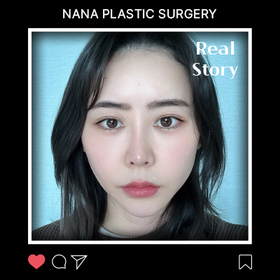 오아라님의 매몰쌍꺼풀, 앞트임 후기