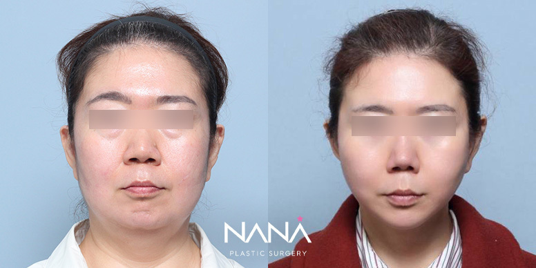 리프팅 전후사진 — 전후사진