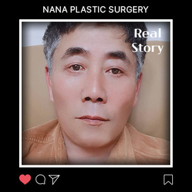 박영봉님의 풀안면거상, 이마거상 후기