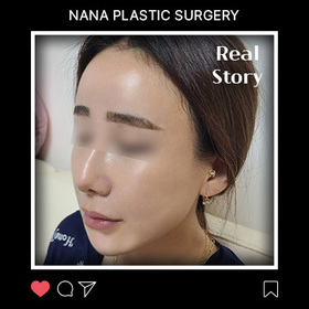 수경모자님의 안면거상 후기
