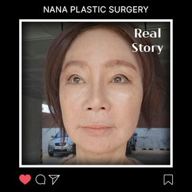 조말숙님의 안면거상 후기