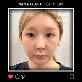 김도은님의 안면윤곽 후기