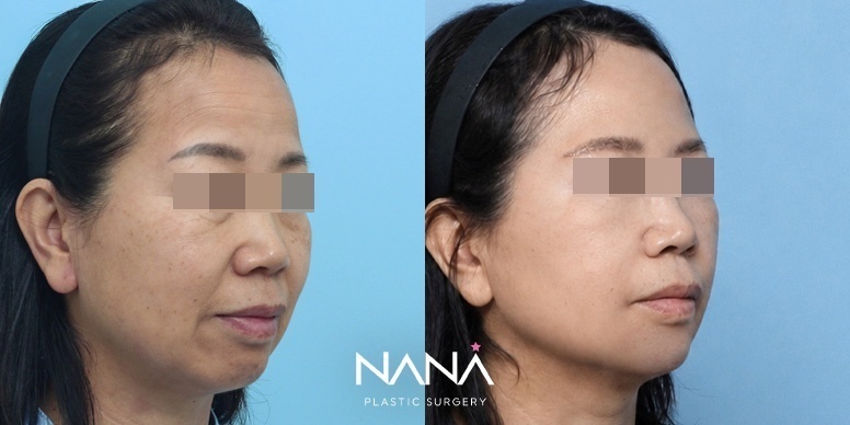 전후사진 전후사진