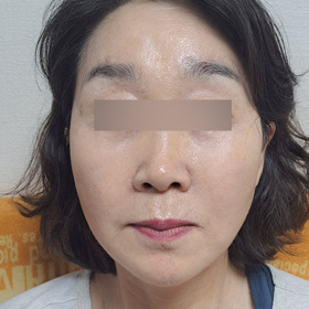 선녀와나뭇꾼님의 안면거상 후기
