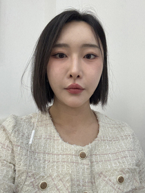 팥빙수조아님의 비절개눈매교정, 듀얼트임 후기