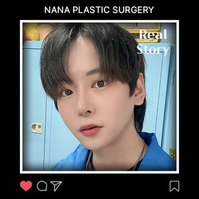 음동규님의 눈썹거상, 코, 심부볼제거 후기