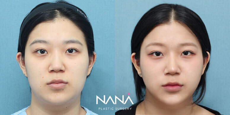 전후사진 전후사진