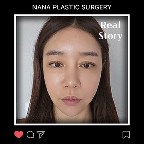 하수정님의 안면거상 후기