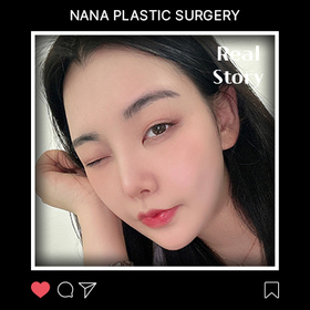 김시은님의 얼굴지방흡입 후기