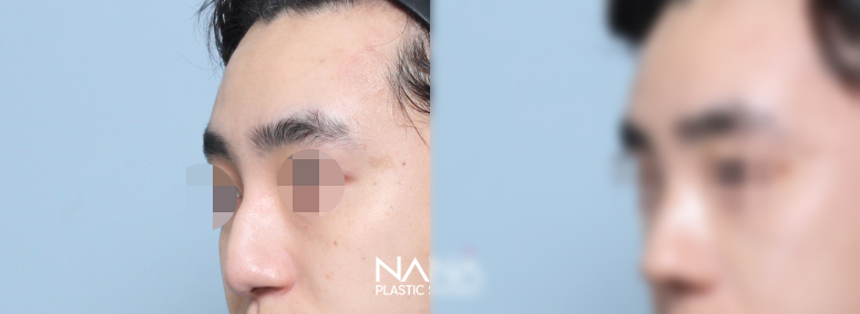 男性整形 术前术后 — 术前术后