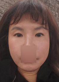 김미선님의 안면거상 후기