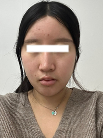 뚜뚜띠띠님의 히든리프팅 후기