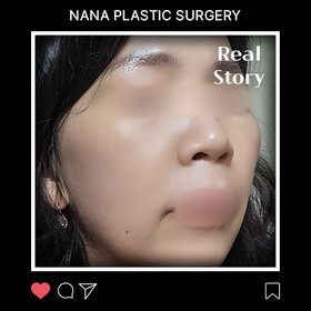박옥기님의 안면거상 후기
