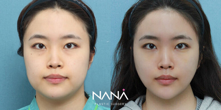 전후사진 전후사진