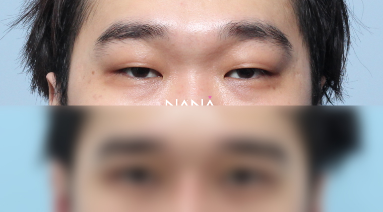 男性整形 术前术后 — 术前术后