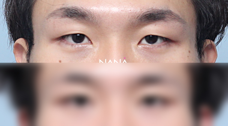 术前术后 术前术后