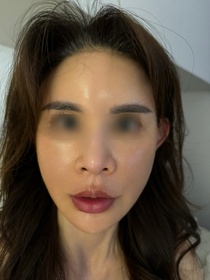 구정리다님의 안면거상 후기