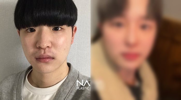남자성형 전후사진 — 전후사진