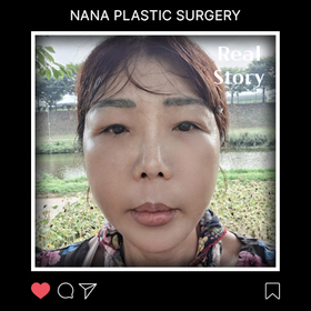 꽃보다스마일님의 안면거상 후기