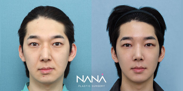 전후사진 전후사진