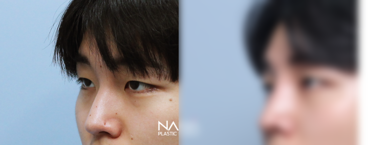 전후사진 전후사진