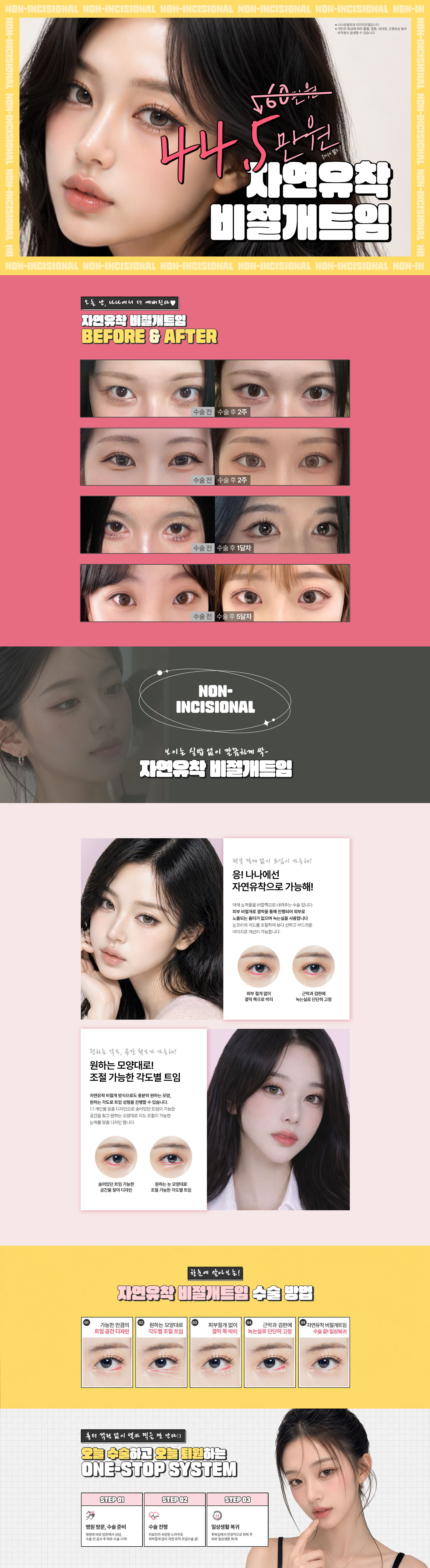 자연유착 비절개 트임