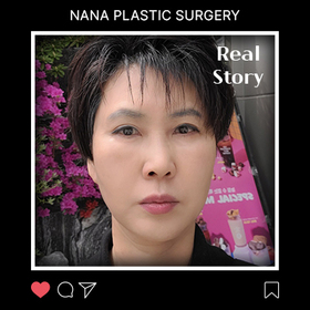 차은영님의 안면거상 후기